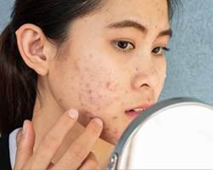 dermatologia acne