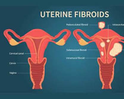 fibromi uterini