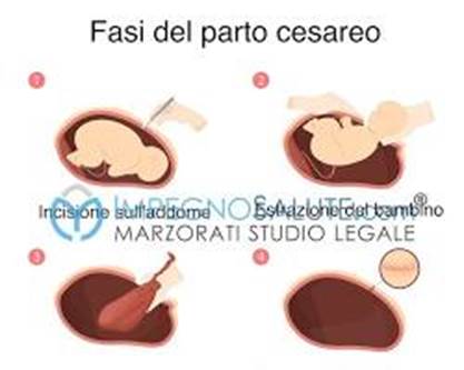 fasi del parto cesareo